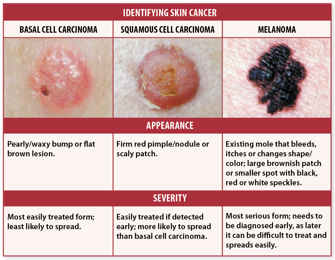 Melanoma Spots On Skin Melanoma Spots On Skin