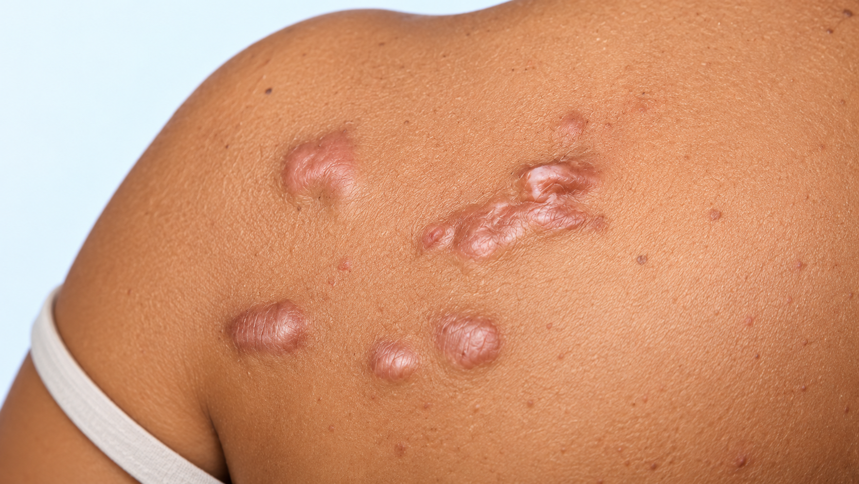 Illustrative close-up of a persistent raised keloid